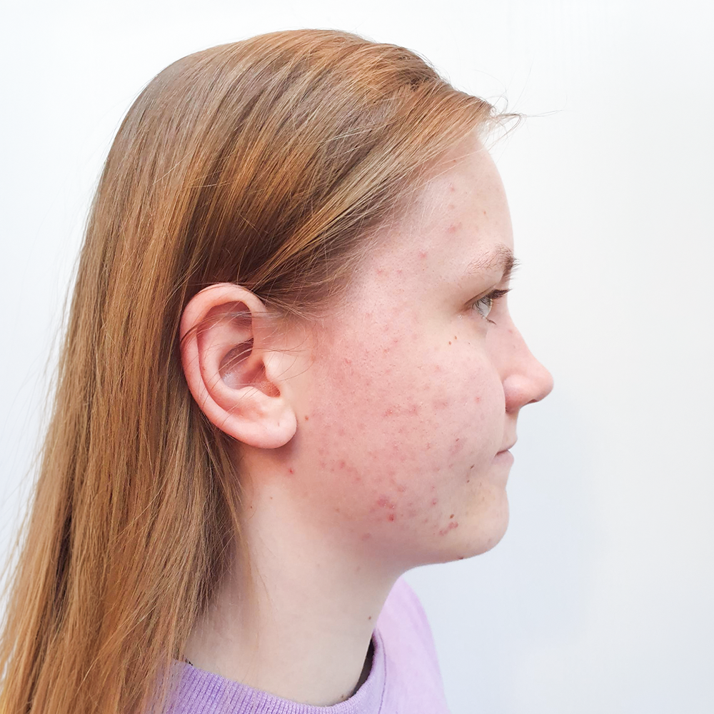 Lea-Sophie Resultate Skin Clear Young fettiger ölige Haut Unreinheiten Pickeln Mitessern Before