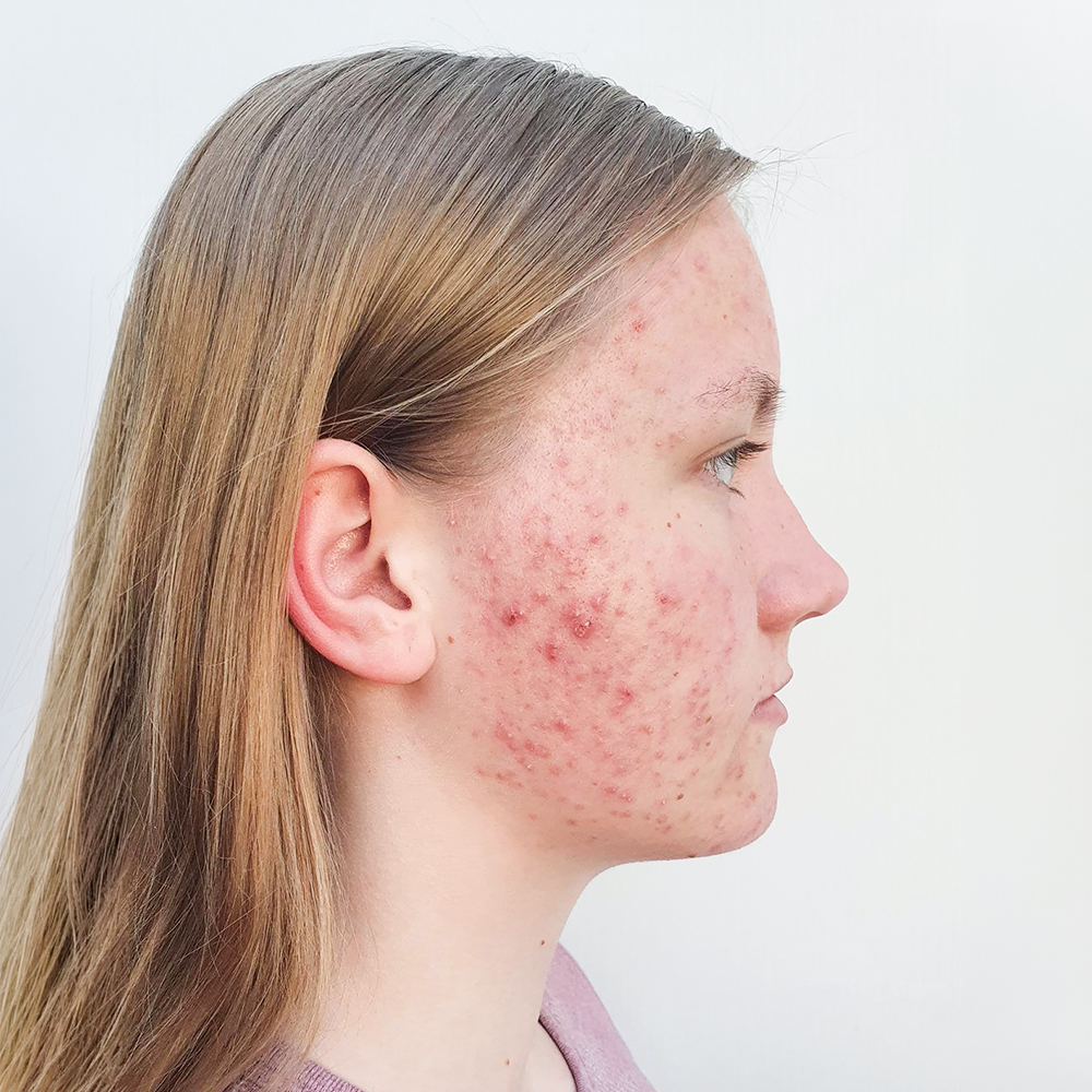 Lea-Sophie Resultate Skin Clear Young fettiger ölige Haut Unreinheiten Pickeln Mitessern Before